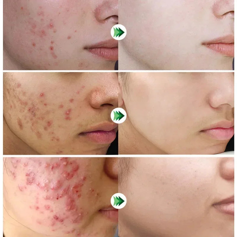 Salicylic Acid