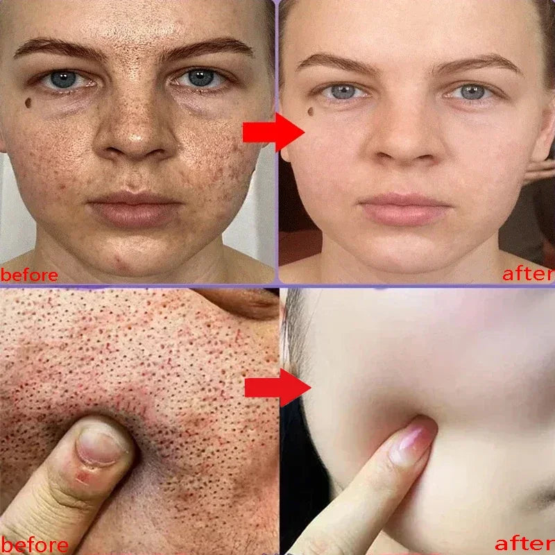 Salicylic Acid
