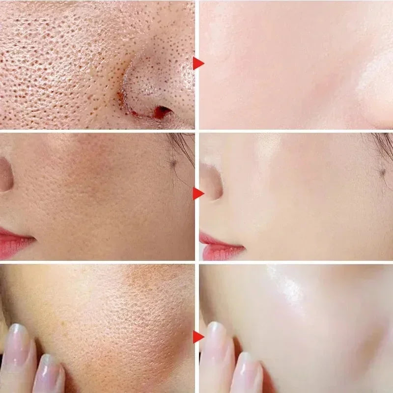 Salicylic Acid